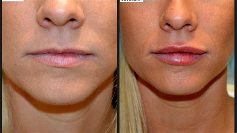 Juvederm Side Effects Lips - Effect Choices