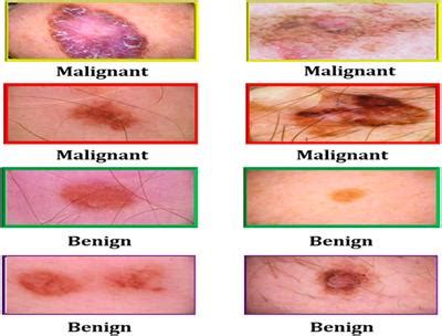 Frontiers | Early and accurate detection of melanoma skin cancer using ...