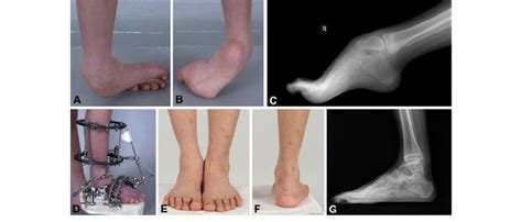 A–G A 10-year-old boy with spastic cerebral palsy, hemiplegic type, who ...