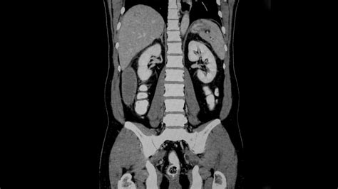 Normal Ct Scan Abdomen