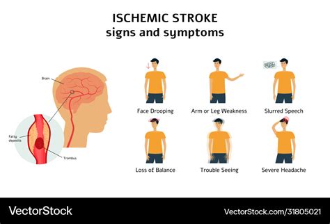 Ischemic stroke signs and symptoms infographic Vector Image