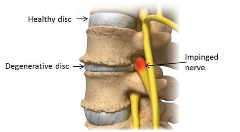 Degenerative Disc Disease and Lower Back Pain