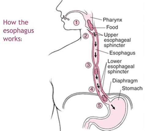 Esophageal dysmotility, esophageal motility disorder, causes, symptoms ...