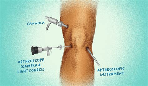 When Is Surgery Necessary For Osteoarthritis Of The Knee?