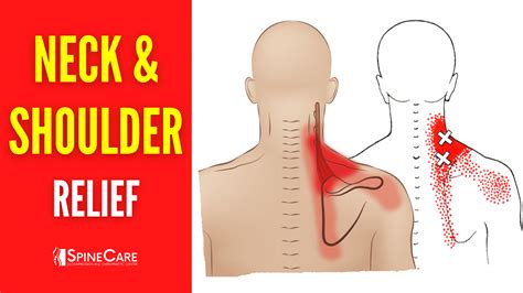 How to Fix Neck and Shoulder Pain FOR GOOD | SpineCare