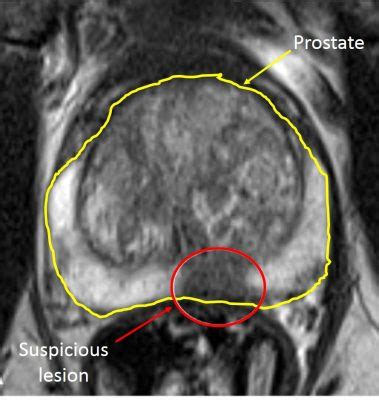 Die zentrale Rolle der multiparametrischen MRT in der Prostatakrebsdiagnose