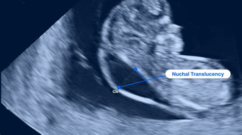 11-Week Ultrasound: Pictures, Fetus Size & What to Expect