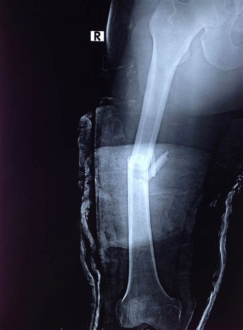 Medial Femoral Condyle Fracture