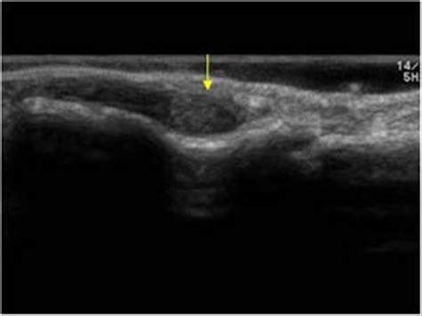 Musculoskeletal Joints and Tendons | 6.4 Fingers : Case 6.4.5 Tumors ...