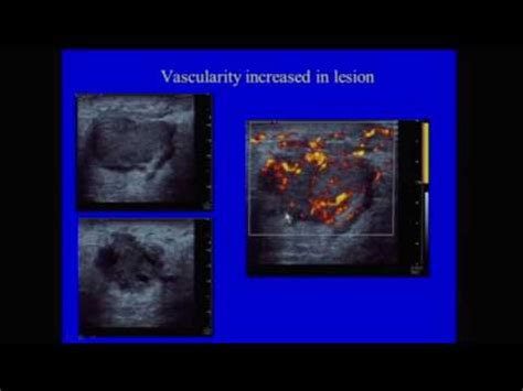 Bi-Rads for Ultrasound - YouTube