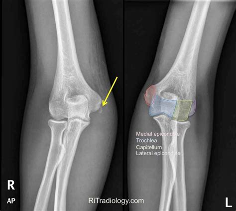 RiT radiology: Medial Epicondyle Fracture of the Humerus