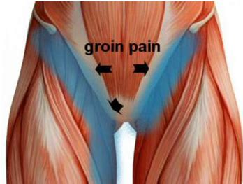 WHAT IS YOUR GROIN PAIN? – RHP Physiotherapy