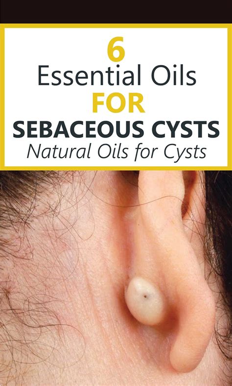 6 Essential Oils For Sebaceous Cysts, Tips and Warnings | Essential ...