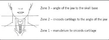 Anatomical boundaries of trauma neck zones as described by Monson et al ...