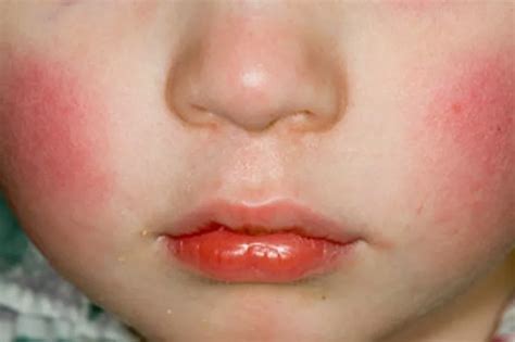 What is 'slapped cheek' syndrome and what are the symptoms? - Dublin Live