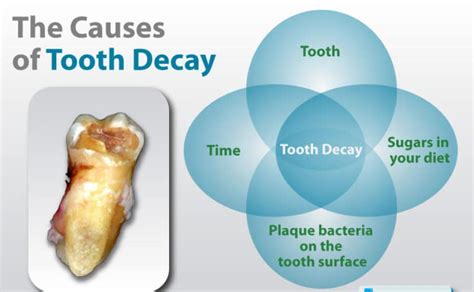 tooth-decay-causes - ABC Dental