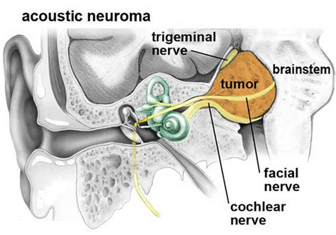 Acoustic Neuroma - Causes, Symptoms, Diagnosis, Treatment