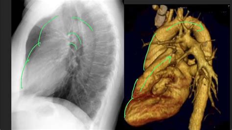 Labeled Lateral Chest X Ray