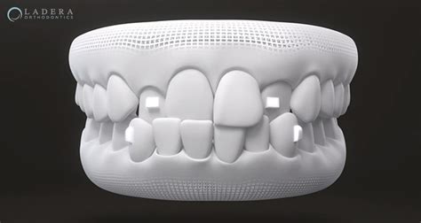 What Are Invisalign Attachments and When Are They Needed?