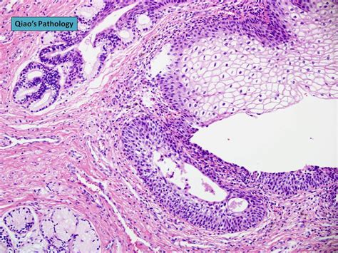 Ovarian Cyst Histology