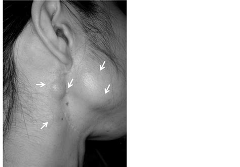 A Case of Pleomorphic Adenoma of the Parotid Gland with Multiple Local ...