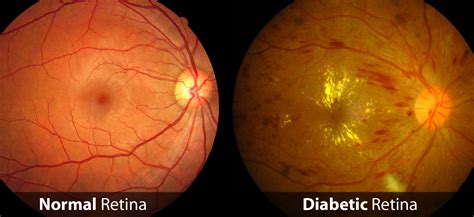 Diabetic Retinopathy: Symptoms, Causes, Treatment & Surgery » How To Relief