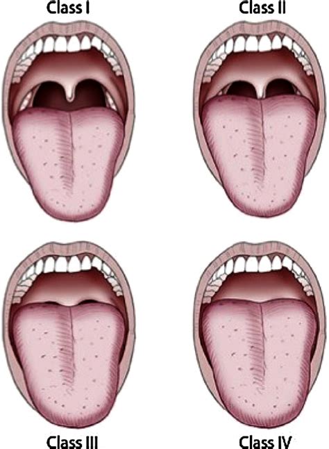 Airway — Pulmcast