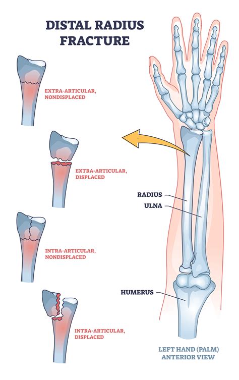 Distal Radius Fracture: What Is It?