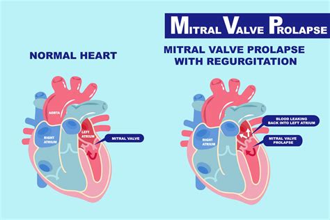 Genetic trigger discovered for common heart problem, mitral valve prolapse