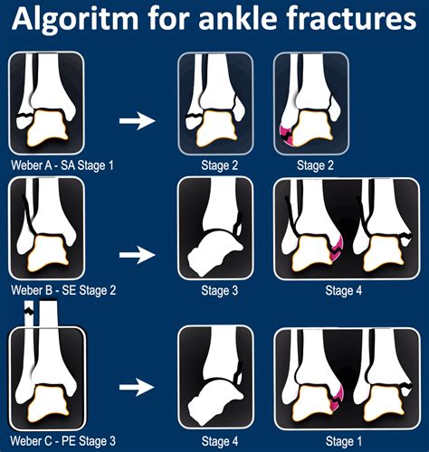 Ankle Fractures Radiology