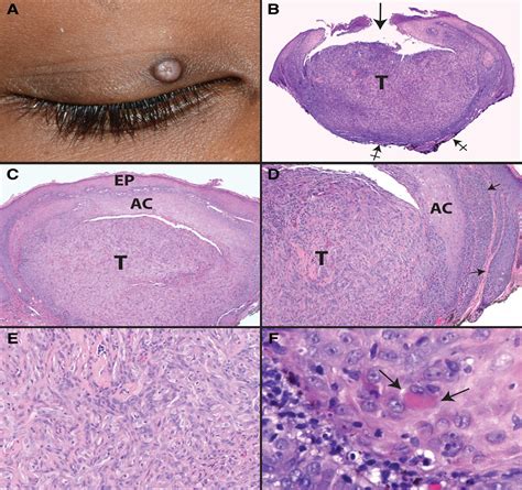 A Hyalinized Trichilemmoma of the Eyelid in a Teenager : Ophthalmic ...