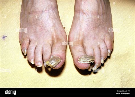 Onychogryphosis Stock Photo - Alamy