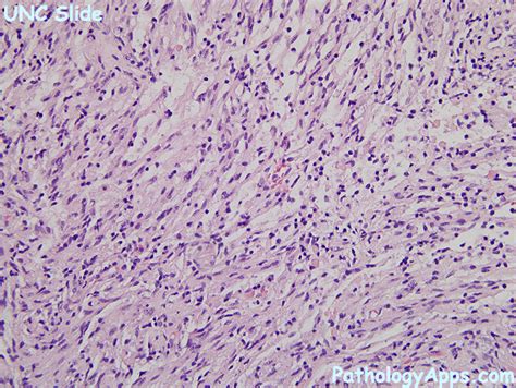 pilocytic astrocytoma pathology