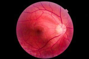 Guide to Ocular Ischemic Syndrome (& Treatment) | NVISION Eye Centers