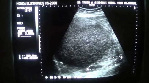 ULTRASOUND: PERINEPHRIC ABSCESS RT - YouTube