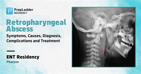 Retropharyngeal Abscess : Symptoms, Causes, Diagnosis, Complications ...