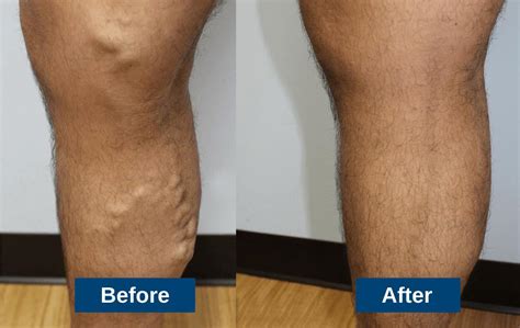 Guide to Varicose Vein Treatments & Which Works Best For You