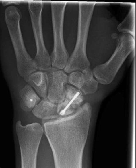 X Ray Of Scaphoid Fracture