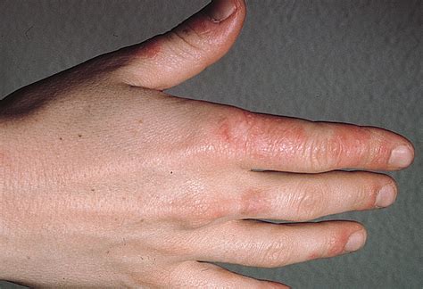 Discoid Lupus Erythematosus–Like Lesions and Stomatitis | Dermatology ...