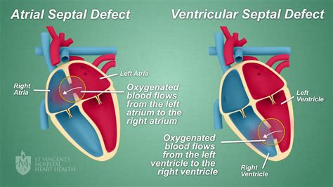 Atrial Ventricular Septal Defect