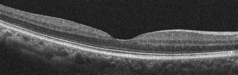 What Are A Macular Pucker and Macular Hole? - Discovery Eye Foundation