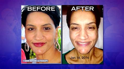 Hear Woman’s Story of Ultherapy Gone Wrong! - YouTube