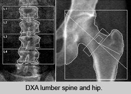 Bone Density Test Chart