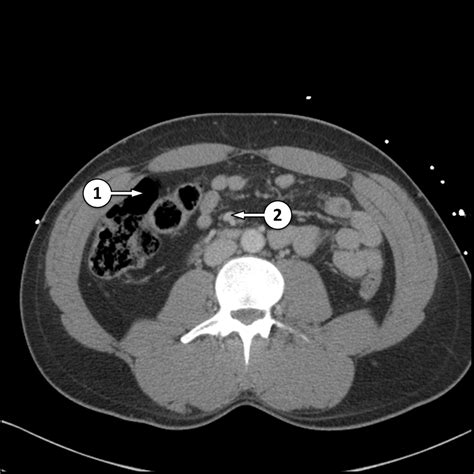 Normal Ct Scan Abdomen