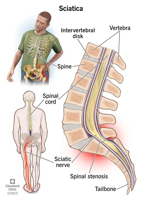 Sciatic Nerve Roots