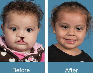 Cleft Lip And Palate - Causes, Prevention & Best Treatment