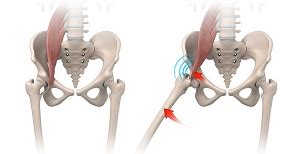 Iliopsoas Impingement Houston, TX | Internal Snapping Hip Syndrome ...