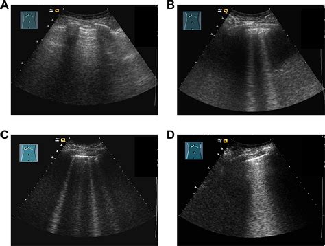 B-Lines Scores Derived From Lung Ultrasound Provide Accurate Prediction ...