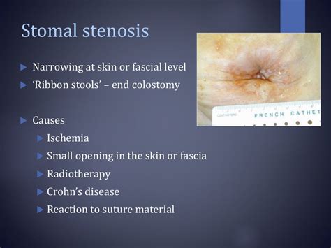 Stoma complications & its management