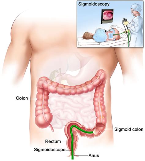 Sigmoidoscopy - Flexible, Rigid Sigmoidoscopy, Prep & Risks